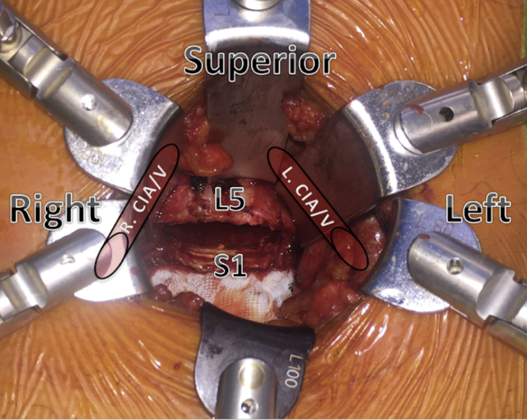 L5 S1 Anterior Lumbar Interbody Fusion Technique Mobbs Journal Of
