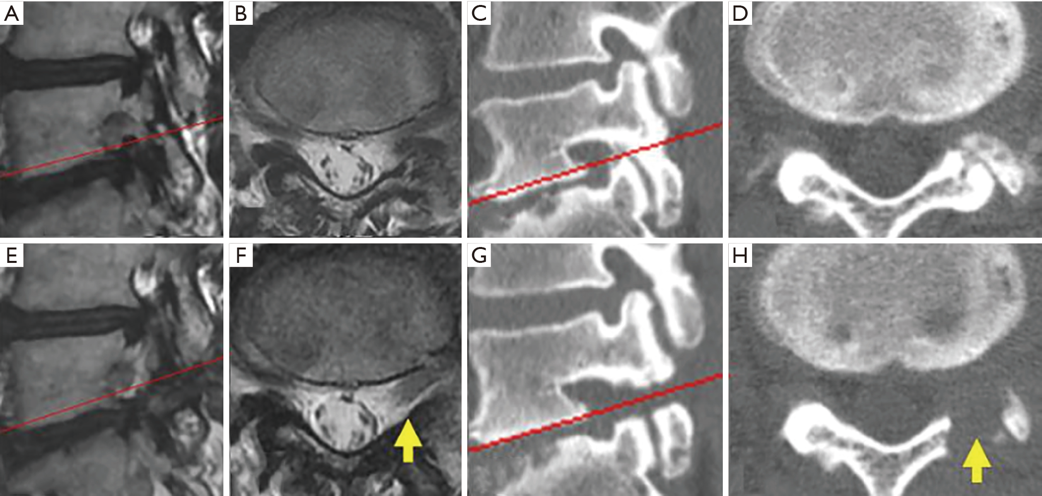 A Less Invasive Surgery Using A Full Endoscopic System For L5 Nerve Root Compression Caused By Lumbar Foraminal Stenosis Ishibashi Journal Of Spine Surgery Foraminal stenosis is a common condition that occurs when the space in the foraminal canal around the nerves narrows. lumbar foraminal stenosis