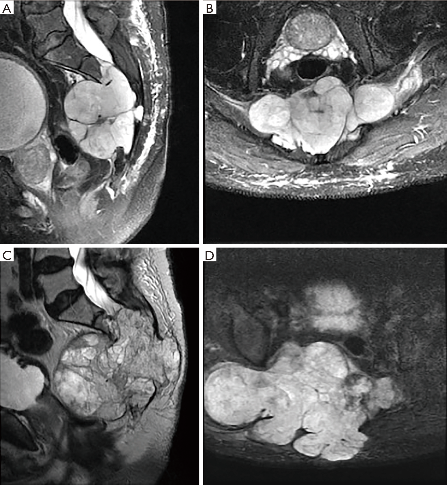 Chordoma Of The Mobile Spine And Sacrum Clinical Management And Prognosis D Amore Journal Of Spine Surgery