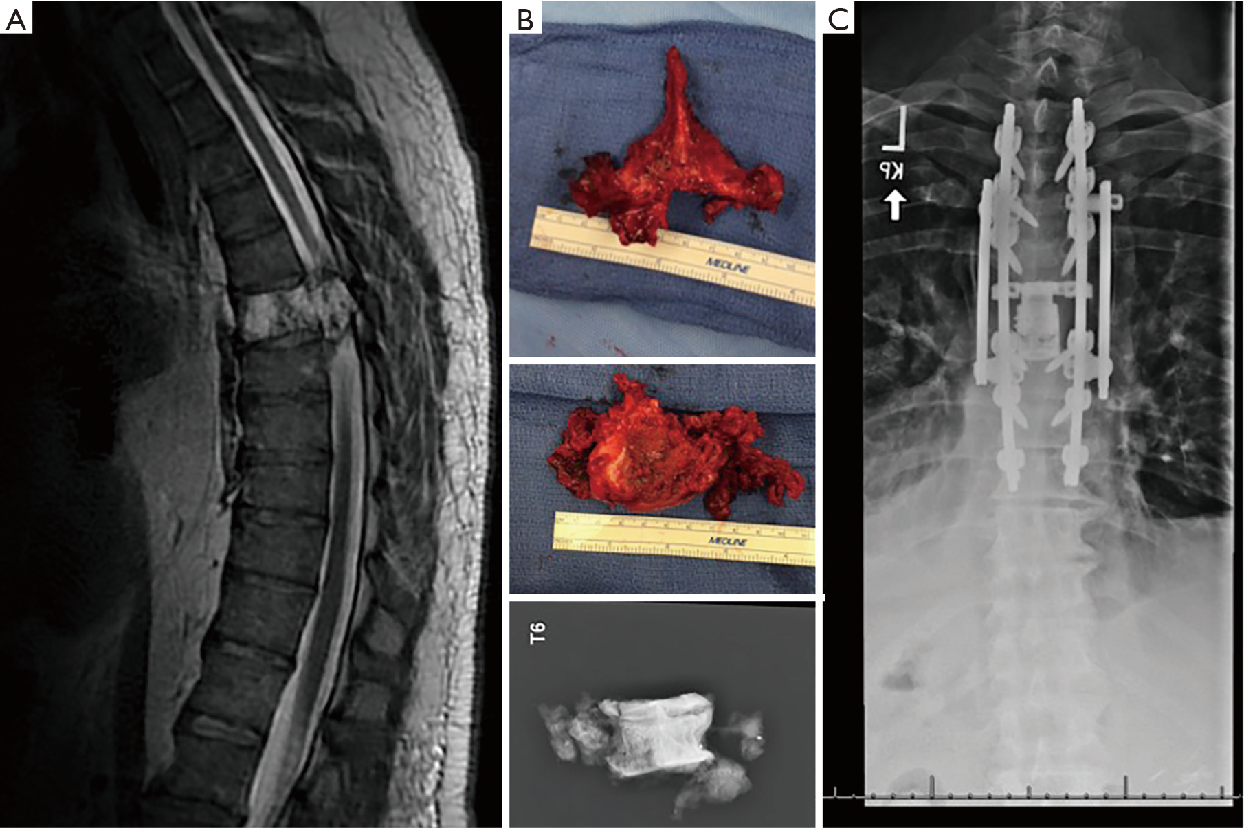 Chordoma Of The Mobile Spine And Sacrum Clinical Management And Prognosis D Amore Journal Of Spine Surgery