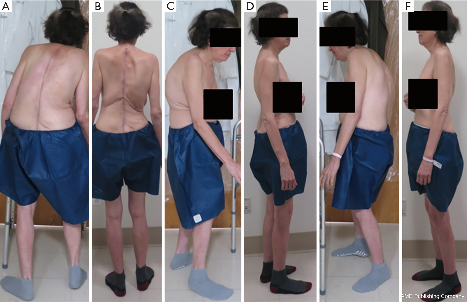 The “Kickstand Rod” technique for correction of coronal imbalance in ...