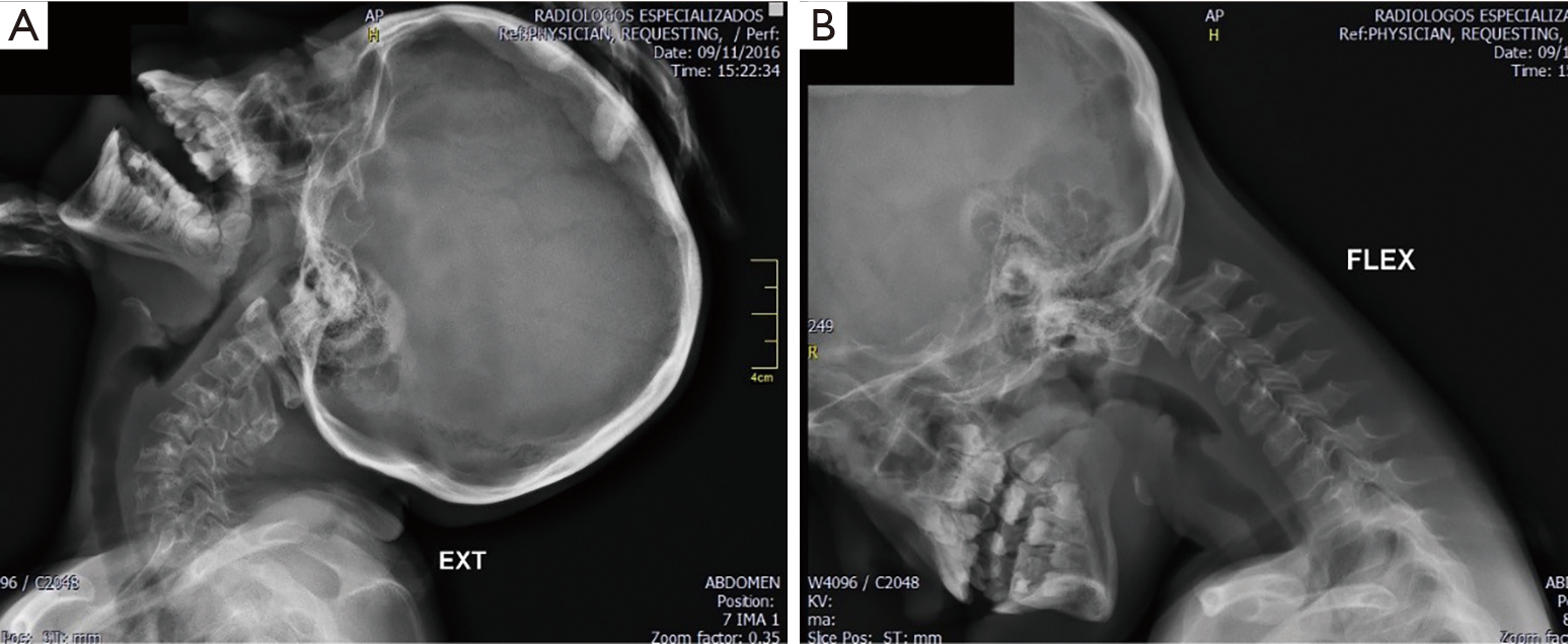 Anterior Atlantoaxial Subluxation With Down Syndrome And Arthritis Case Report Prada Journal Of Spine Surgery