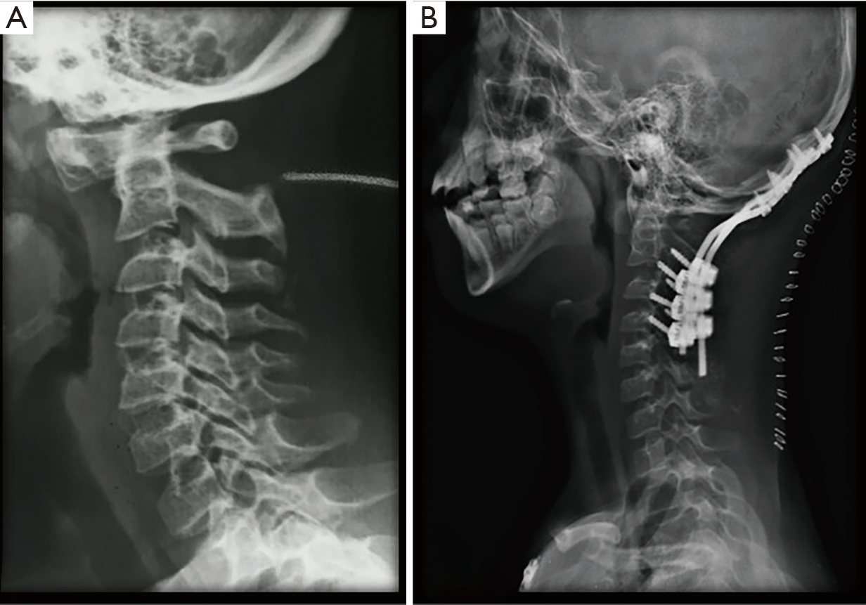Anterior Atlantoaxial Subluxation With Down Syndrome And Arthritis Case Report Prada Journal Of Spine Surgery
