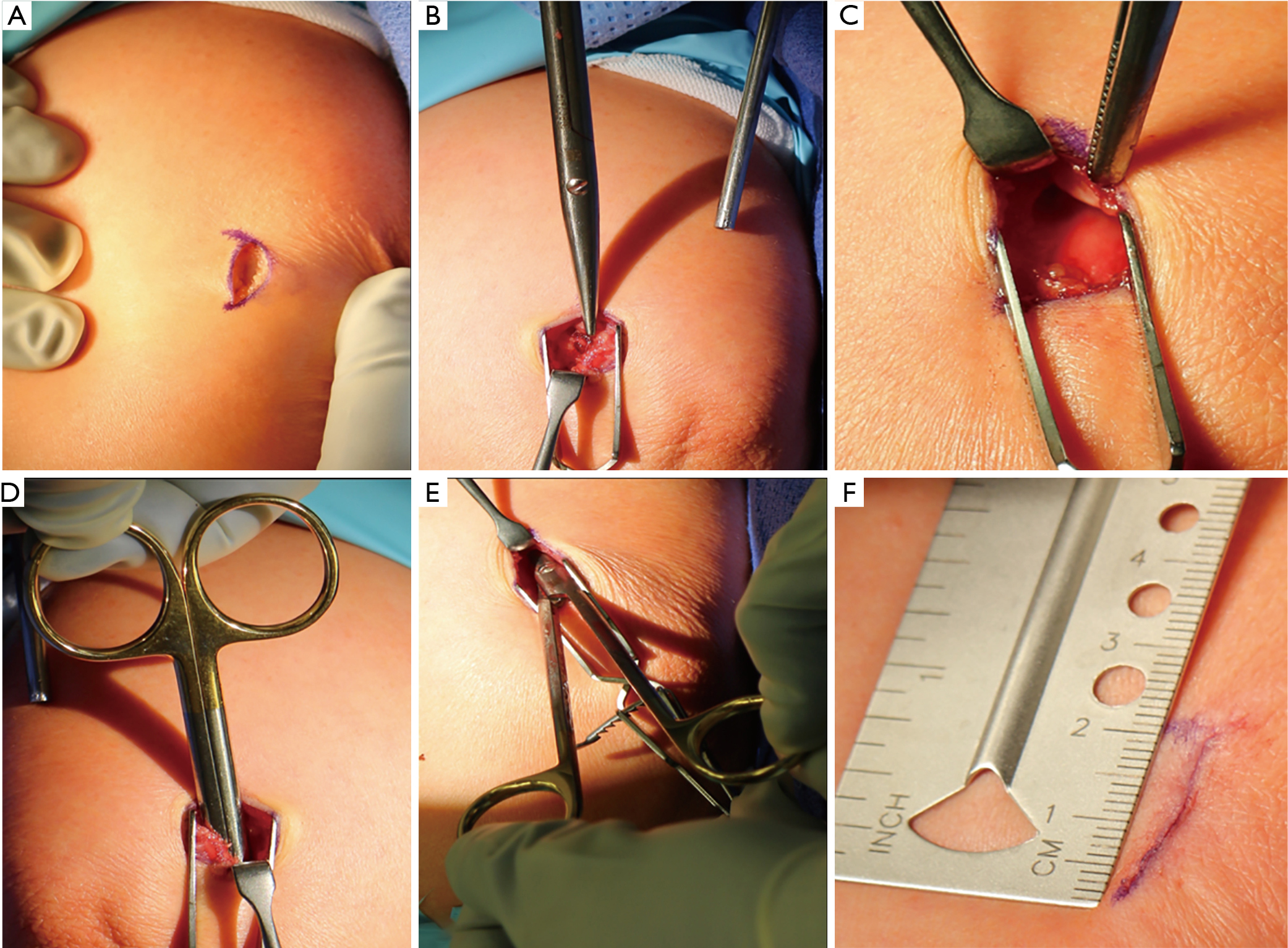 Novel Minimally Invasive Technique In The Treatment Of Cubital Tunnel Syndrome Khalid Journal Of Spine Surgery