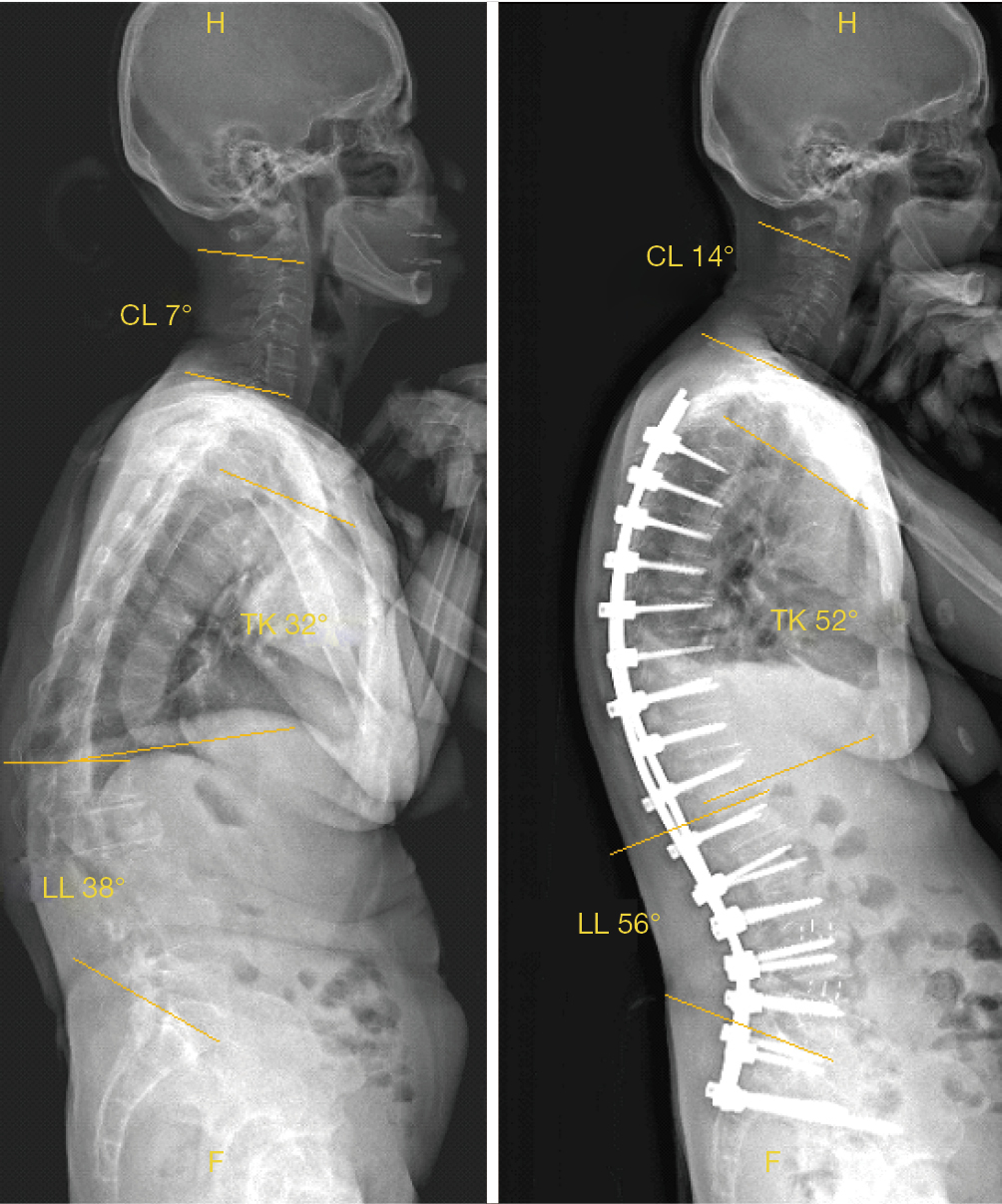 Sagittal alignment of the cervical spine do we know enough for