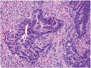 Colorectal carcinoma: Pathologic aspects - Fleming - Journal of ...