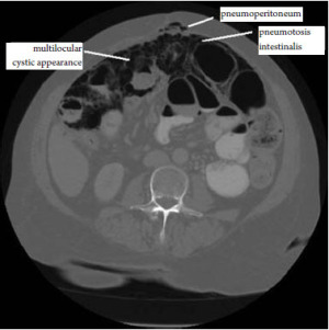 Benign Multicystic Peritoneal Mesothelioma A Rare Case Presenting As Pneumoperitoneum And Pneumotosis Intestinalis Snyder Journal Of Gastrointestinal Oncology