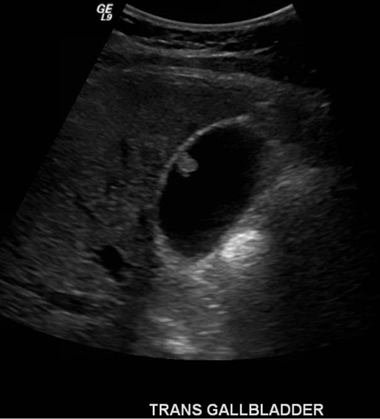 Pyloric Gland Adenoma Of Gallbladder Reports Of Two Cases And A Brief Review Of Literature Yang Journal Of Gastrointestinal Oncology