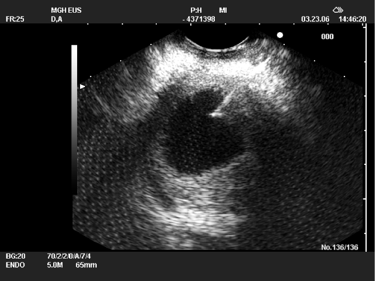 Diagnosis And Management Of Cystic Lesions Of The Pancreas Brugge Journal Of Gastrointestinal Oncology