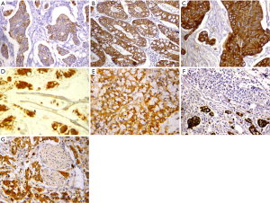 c-MET expression in colorectal adenomas and primary carcinomas 