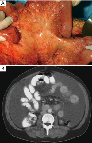 ck7 positive mesothelioma