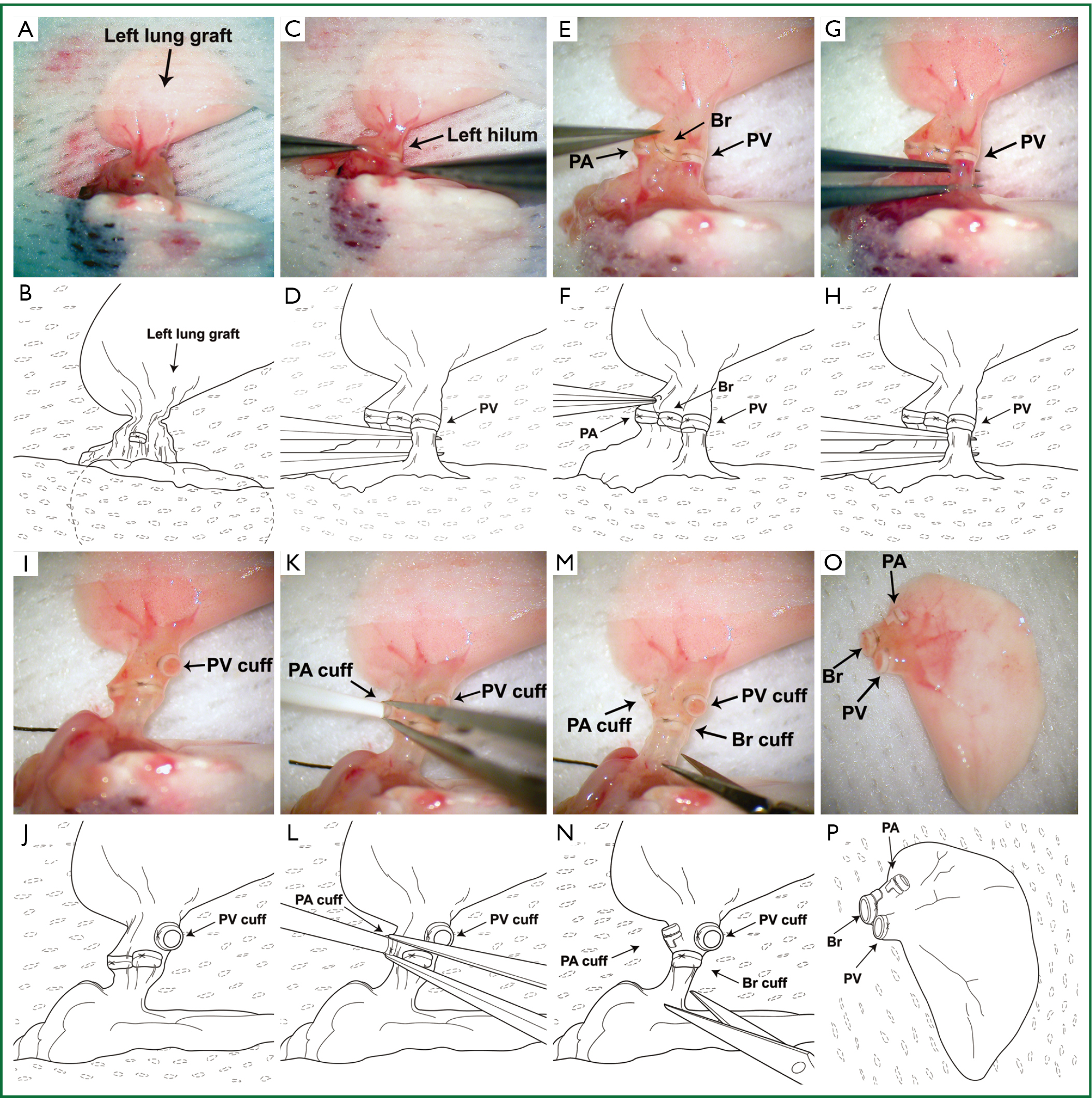 Surgical Technique For Lung Retransplantation In The Mouse Li Journal Of Thoracic Disease The main indications are primary graft failure, hepatic arterial thrombosis and chronic. lung retransplantation in the mouse