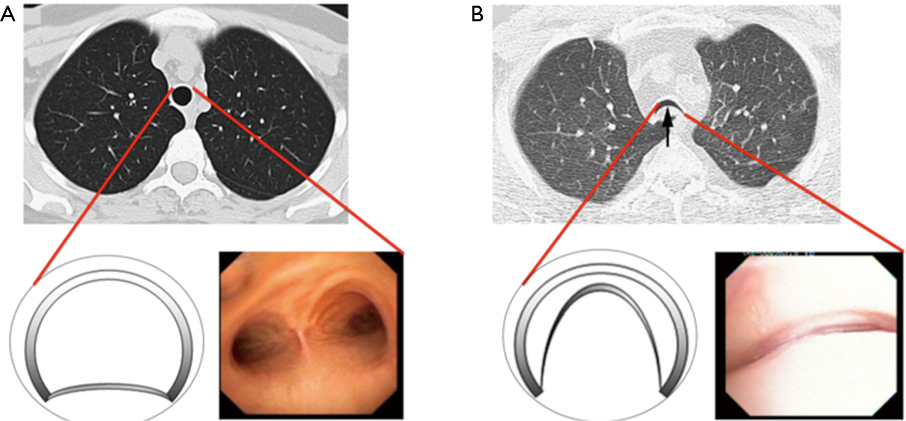 Current concepts in severe adult tracheobronchomalacia evaluation and