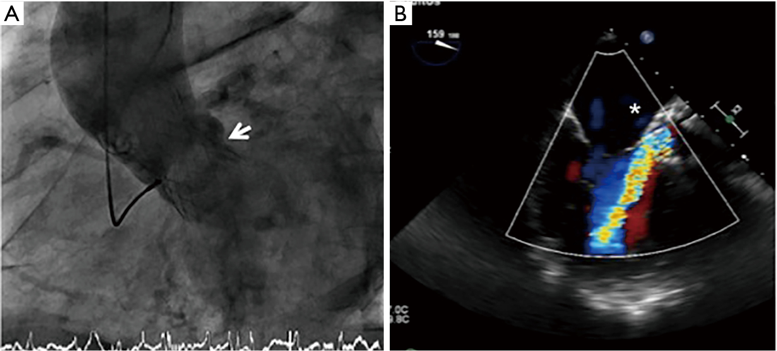Percutaneous Paravalvular Leak Closure After Corevalve Transcatheter Aortic Valve Implantation Using An Arterio Arterial Loop Estevez Loureiro Journal Of Thoracic Disease Paravalvular leak (pvl) after tavr, however, remains a major limitation for early generation devices, with up to 11% of patients experiencing moderate to severe regurgitation after valve deployment. percutaneous paravalvular leak closure
