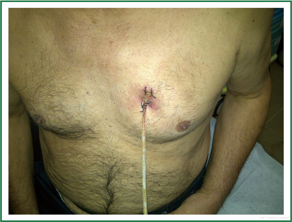 The Use Of Jackson Pratt Silicone Flat Drains As Prolonged Pleural Catheters For The Management Of Pleural Effusions Demirhan Journal Of Thoracic Disease
