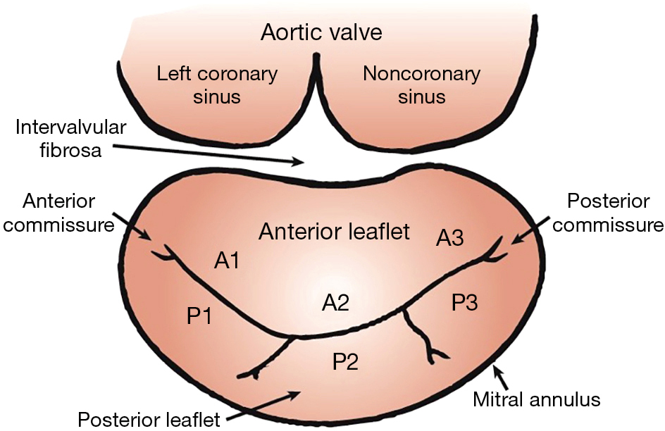Multimodality imaging assessment of mitral valve anatomy in planning