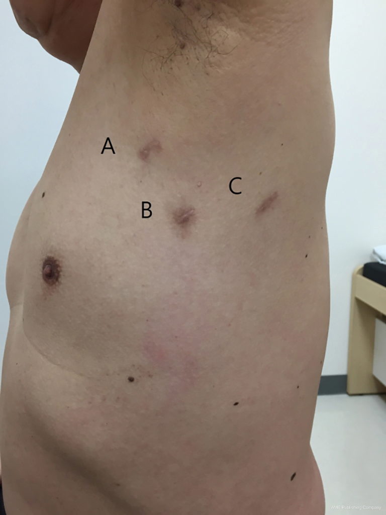 Video Assisted Thoracoscopic Surgery For Intrathoracic First Rib Resection In Thoracic Outlet Syndrome Hwang Journal Of Thoracic Disease