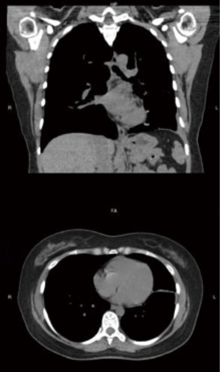 Tuberculous tracheobronchial stenosis avoiding resection—when less is