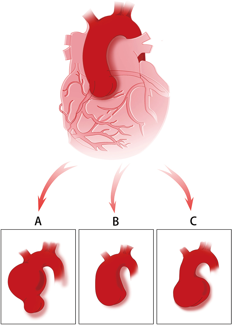 Should Sinus Of Valsalva Be Preserved In Patients With Bicuspid Aortic Valve And Aortic Dilation Wang Journal Of Thoracic Disease Should Sinus Of Valsalva Be Preserved In Patients With Bicuspid Aortic Valve And Aortic Dilation Wang Journal Of Thoracic Disease