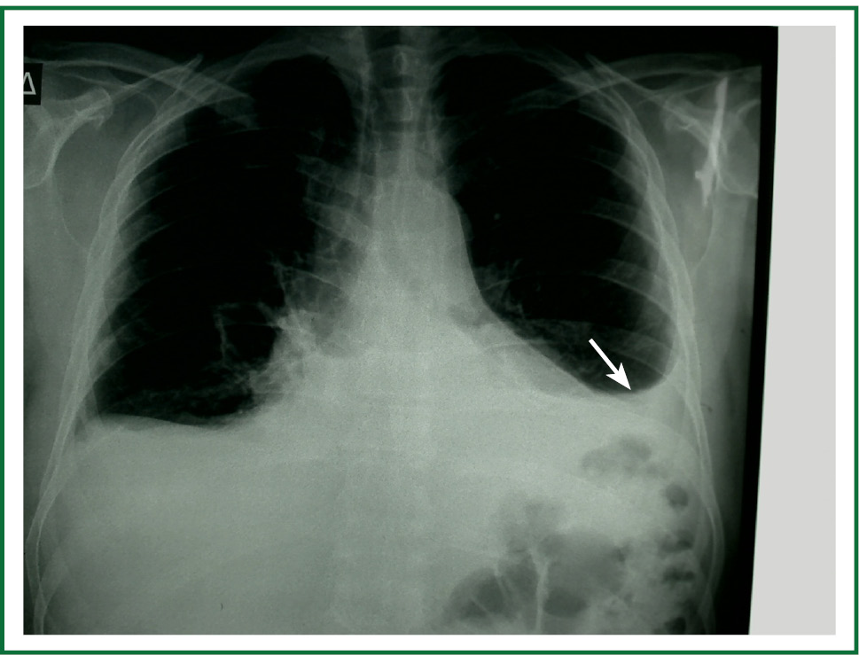 Meniscus Sign Pleural Effusion