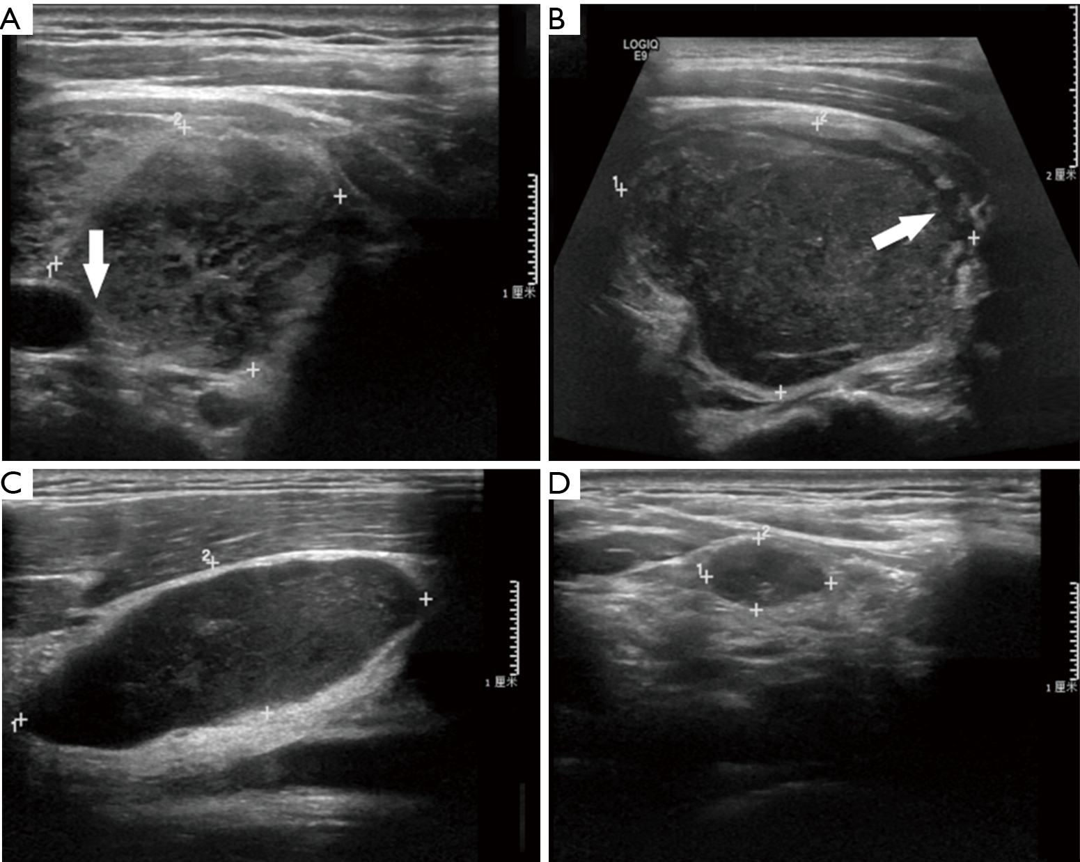 Comparison Of Sonographic Characteristics Of Primary Thyroid Lymphoma And Anaplastic Thyroid Carcinoma Gu Journal Of Thoracic Disease