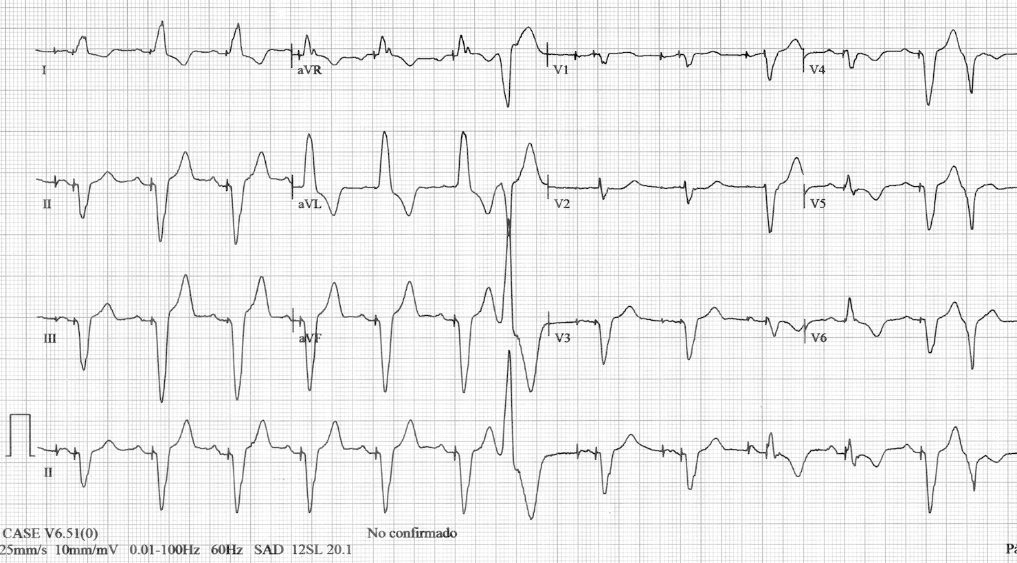 Different Qrs Morphologies In A Dual Chamber Pacemaker What Is The Mechanism Gutierrez Journal Of Thoracic Disease Different Qrs Morphologies In A Dual Chamber Pacemaker What Is The Mechanism Gutierrez Journal Of Thoracic Disease