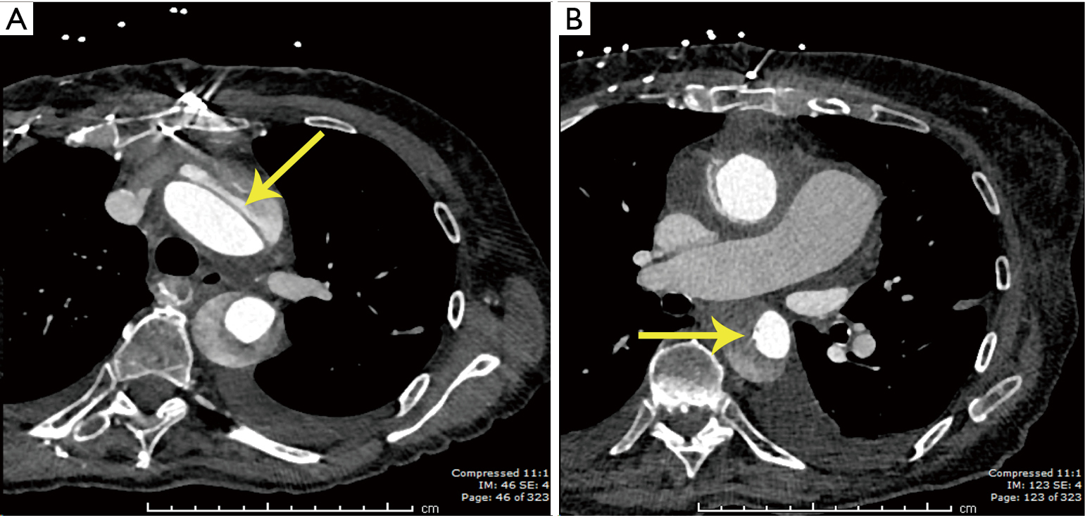 Intraoperative descending aortic dissection during aortic root
