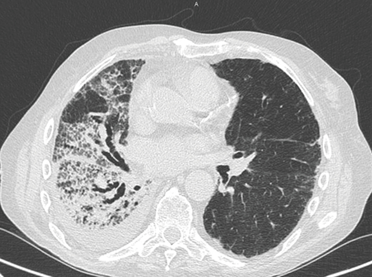 The role of radiology in the evaluation of the immunotherapy efficacy
