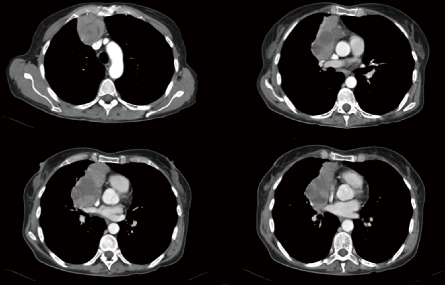 Extended resections of large thymomas importance of en bloc thymectomy