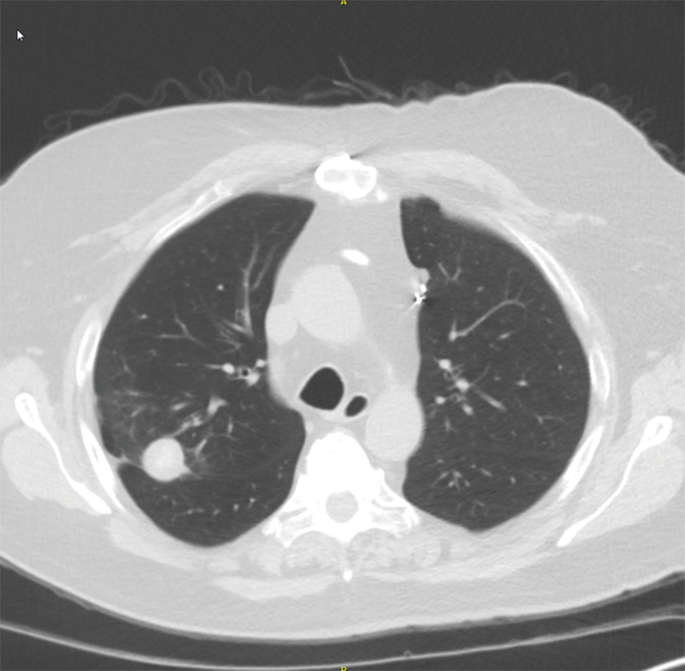 Yeast infection in lungs clearance