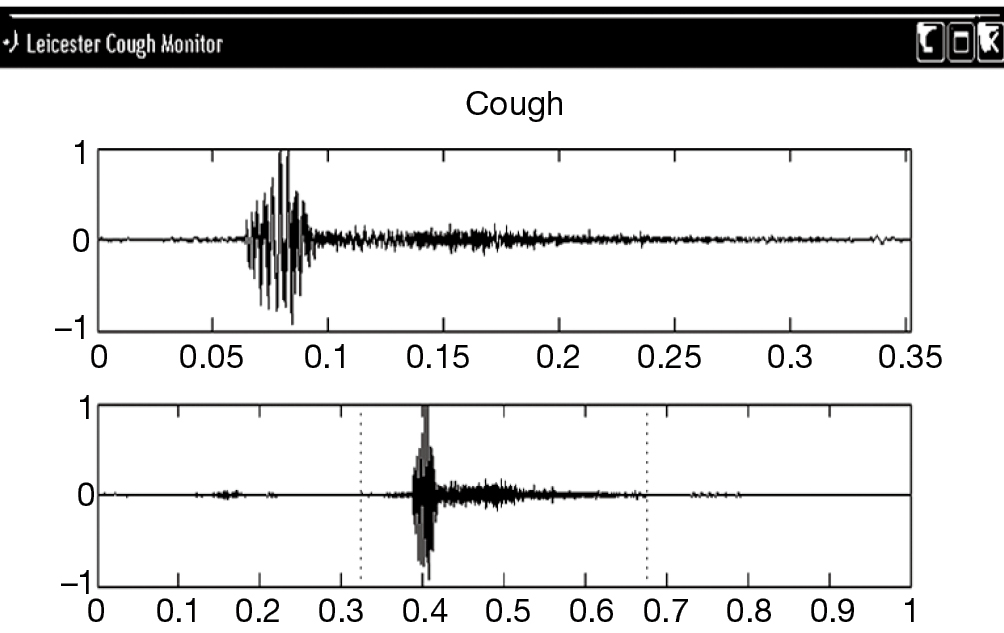 Arnold S Nerve Cough Reflex Evidence For Chronic Cough As A Sensory Vagal Neuropathy Ryan Journal Of Thoracic Disease
