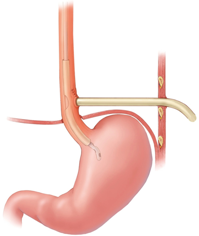 Management Of Traumatic Esophageal Injuries Sudarshan Journal Of Thoracic Disease