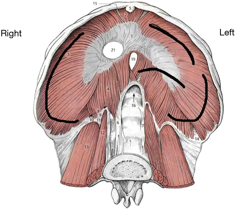 Surgical management of chronic diaphragmatic hernias Filosso Journal of Thoracic Disease
