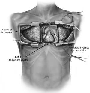 The surgical technique of bilateral sequential lung transplantation -  Hayanga - Journal of Thoracic Disease