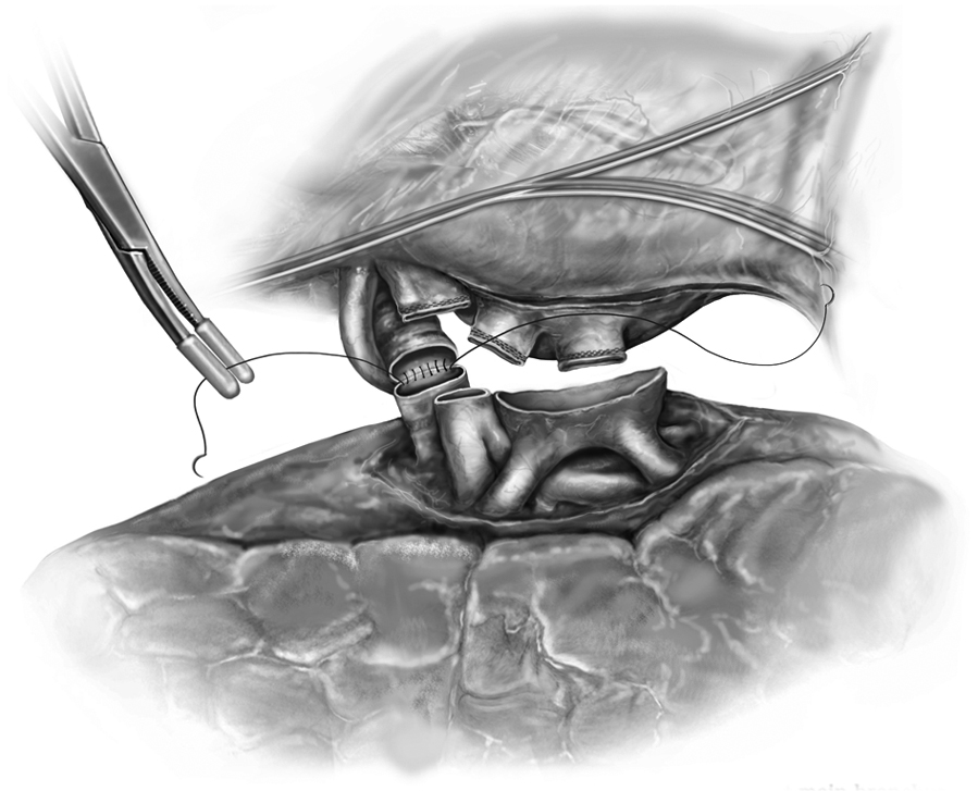 The surgical technique of bilateral sequential lung transplantation