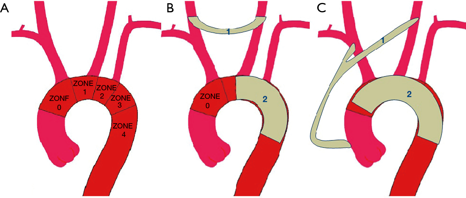 Off Pump Hybrid Extra Anatomic Techniques For Aortic Arch Repair Own Experience Buczkowski Journal Of Thoracic Disease Completely extrathoracic debranching techniques for zone 0 sealing with tevar are limited. aortic arch repair