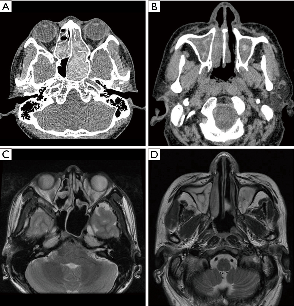 The Use Of Magnetic Resonance Imaging In Differential Diagnosis Of Allergic Fungal Sinusitis And Eosinophilic Mucin Rhinosinusitis Meng Journal Of Thoracic Disease