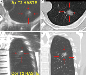 Magnetic resonance imaging for lung cancer screen - Wang - Journal of ...