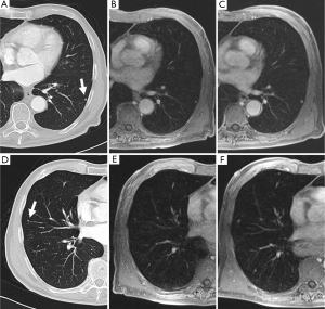 Magnetic resonance imaging lung cancer screen - - Journal of Thoracic Disease