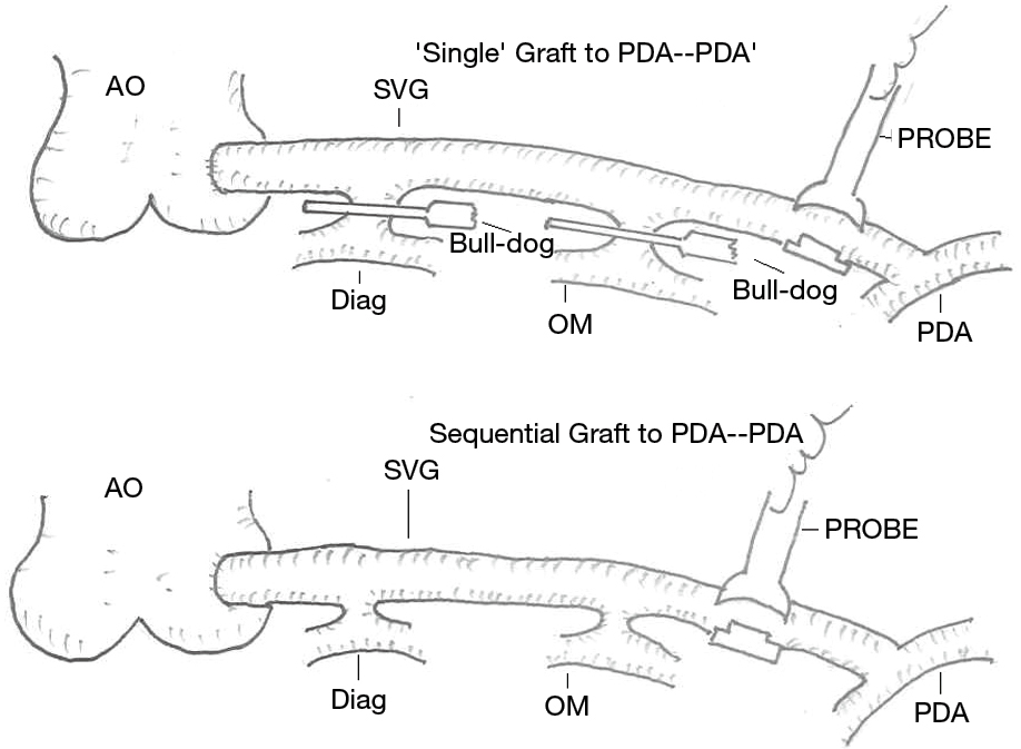 Download Comparison Of Blood Flow In Single And Sequential Vein Grafts During Off Pump Coronary Artery Bypass Li Journal Of Thoracic Disease