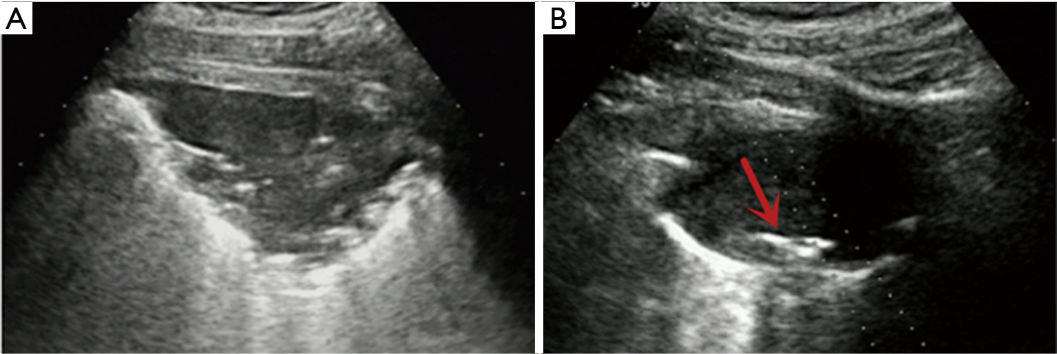 Hemoptysis complicating ultrasound-guided transthoracic needle lung ...