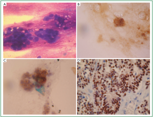 Thyroid gland metastasis from small cell lung cancer: an unusual site ...