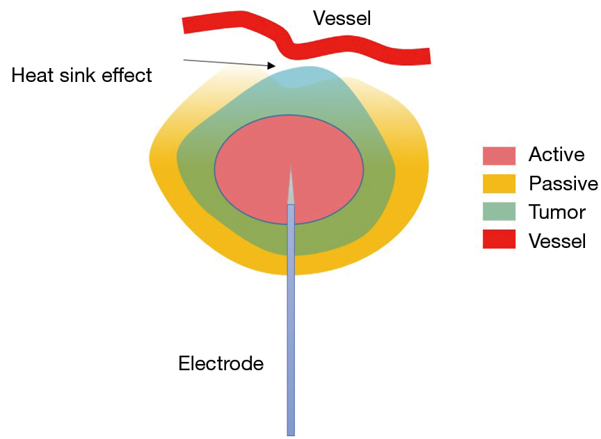 Image guided thermal ablation in lung cancer treatment Lin Journal
