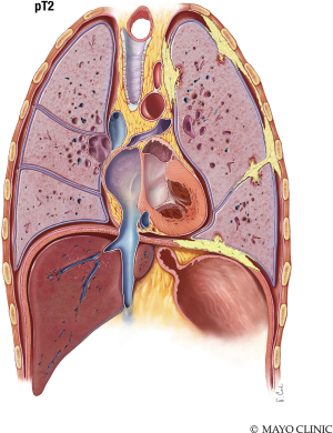 what are the stages of pleural mesothelioma