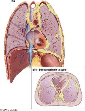 four types of malignant mesothelioma