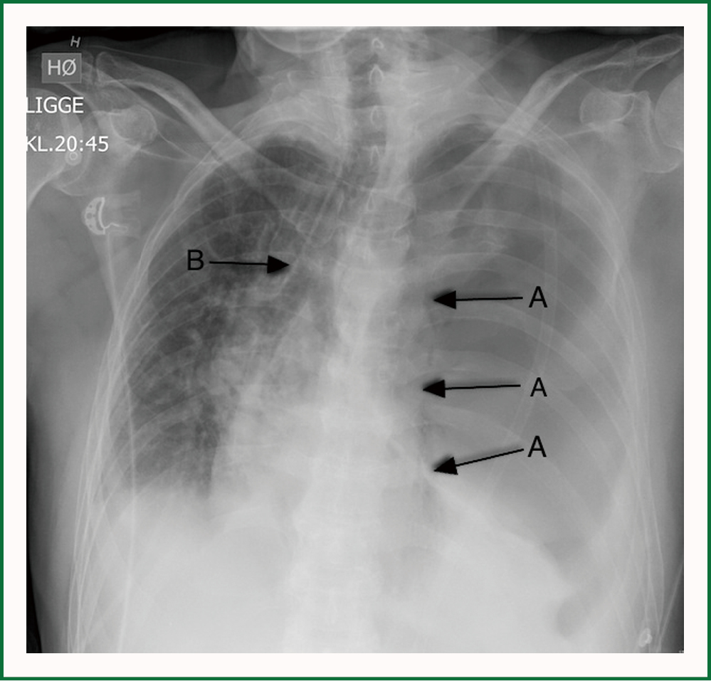 Boerhaave S Syndrome And Tension Pneumothorax Secondary To Norovirus Induced Forceful Emesis Veno Journal Of Thoracic Disease