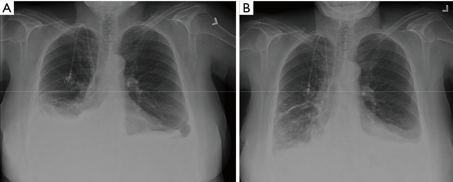 malignant pleural effusion related to breast cancer