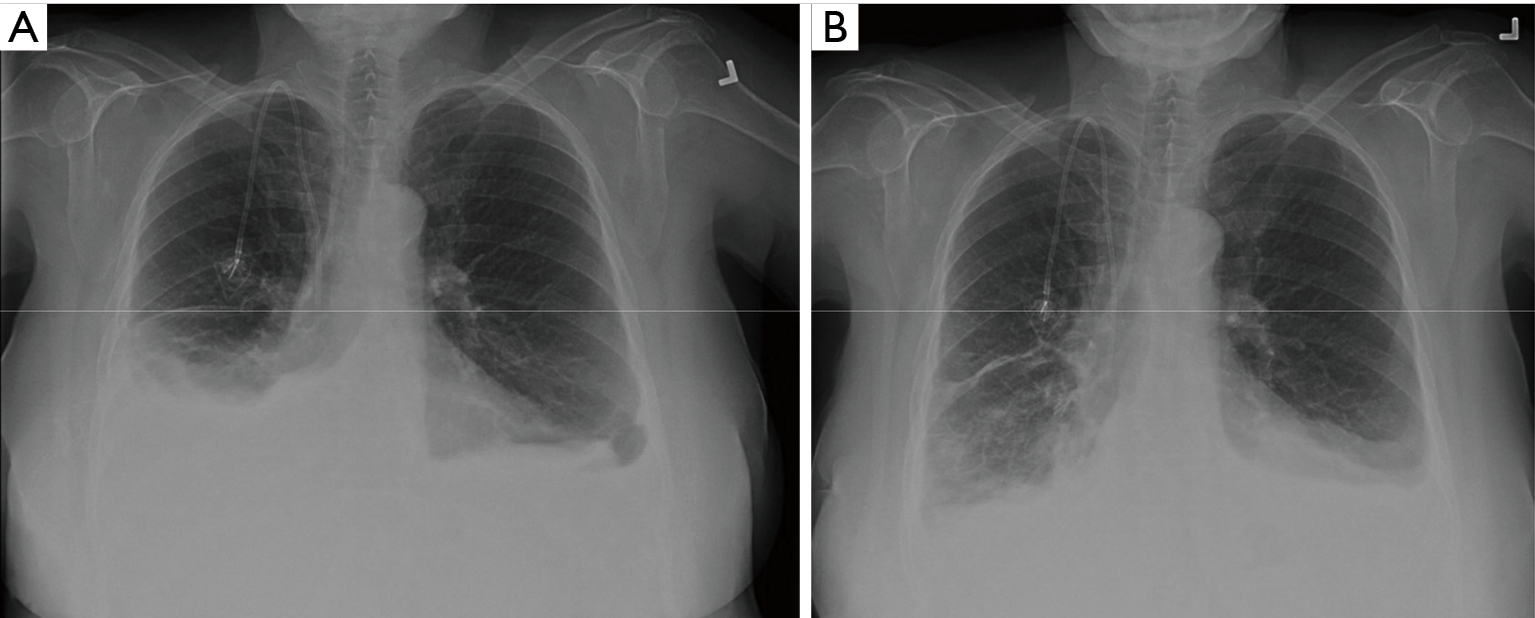 spelling of asbestosis