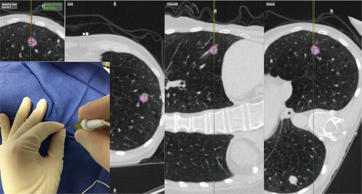 Navigational transbronchial needle aspiration, percutaneous needle