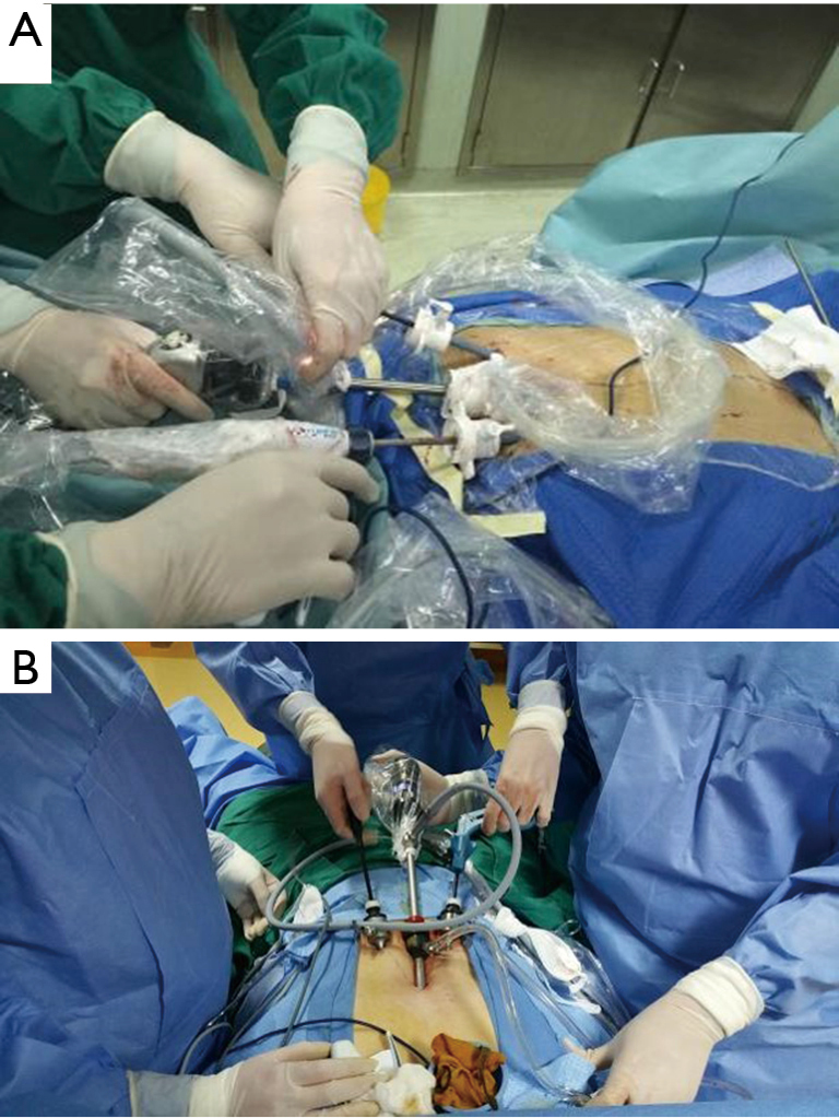Subcostal thoracoscopic extended thymectomy for patients with